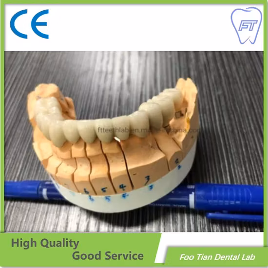 Fixed Restoration Dental Metal Ceramic Crown Made in Foo Tian Dental Lab in Shenzhen China