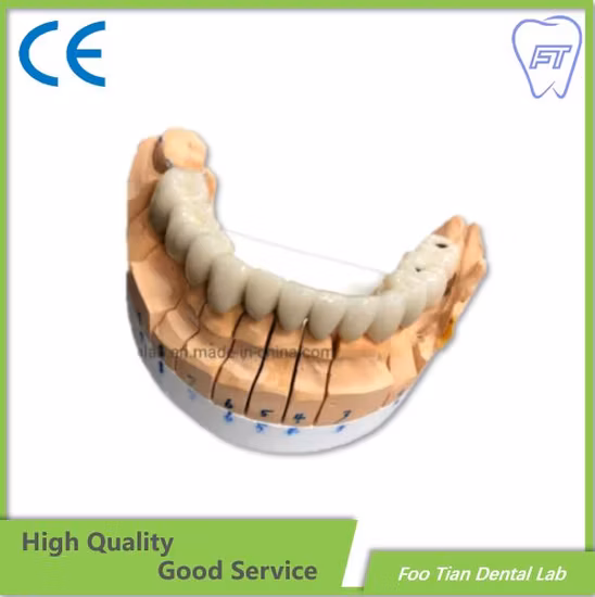 Fixed Restoration Dental Metal Ceramic Crown Made in Foo Tian Dental Lab in Shenzhen China