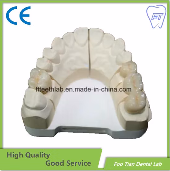 Fixed Restoration Dental Metal Ceramic Crown Made in Foo Tian Dental Lab in Shenzhen China
