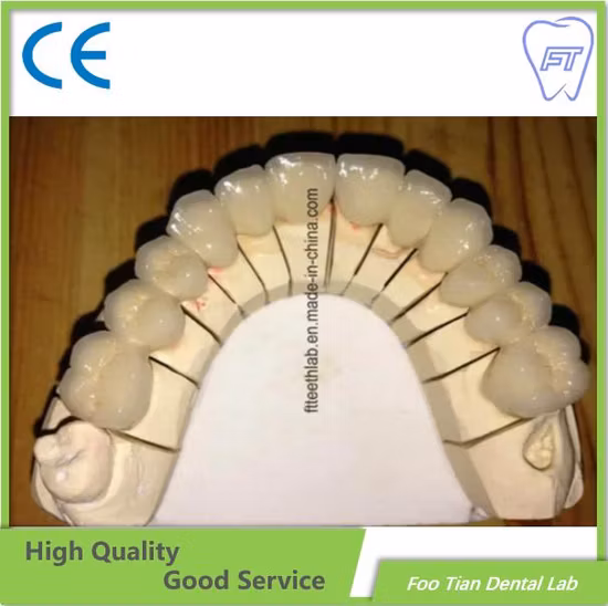 Fixed Restoration Dental Metal Ceramic Crown Made in Foo Tian Dental Lab in Shenzhen China