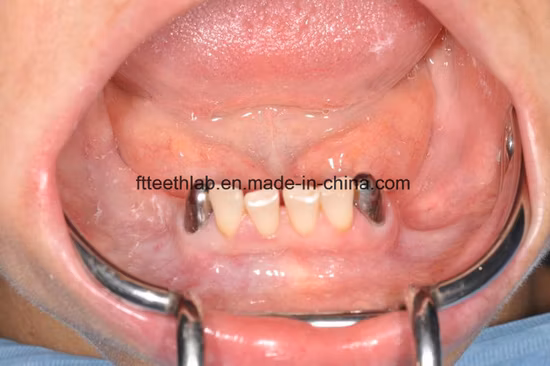 Abnehmbare Teleskop-Teilprothesen aus Metallguss, hergestellt im China Dental Lab
