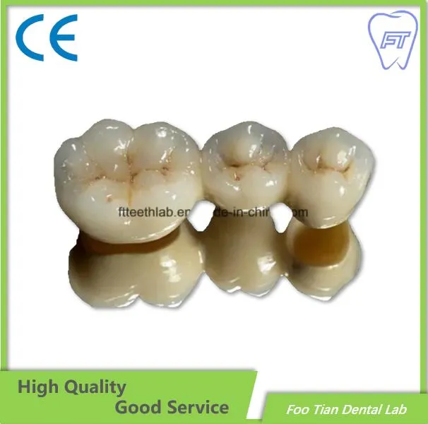 Festsitzende zahnmedizinische Metallkeramikkrone, hergestellt im Foo Tian Dental Lab in Shenzhen, China