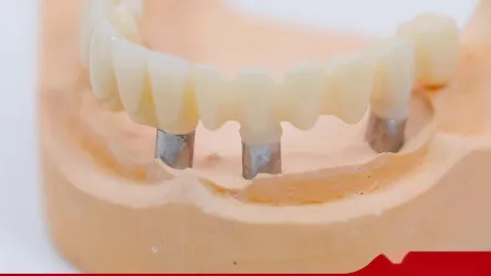 3D-Druck in der Zahnmedizin für Implantatkronen